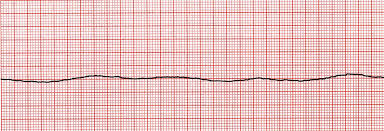 B20: Cardiac Asystole: ECGs at St Emlyn's